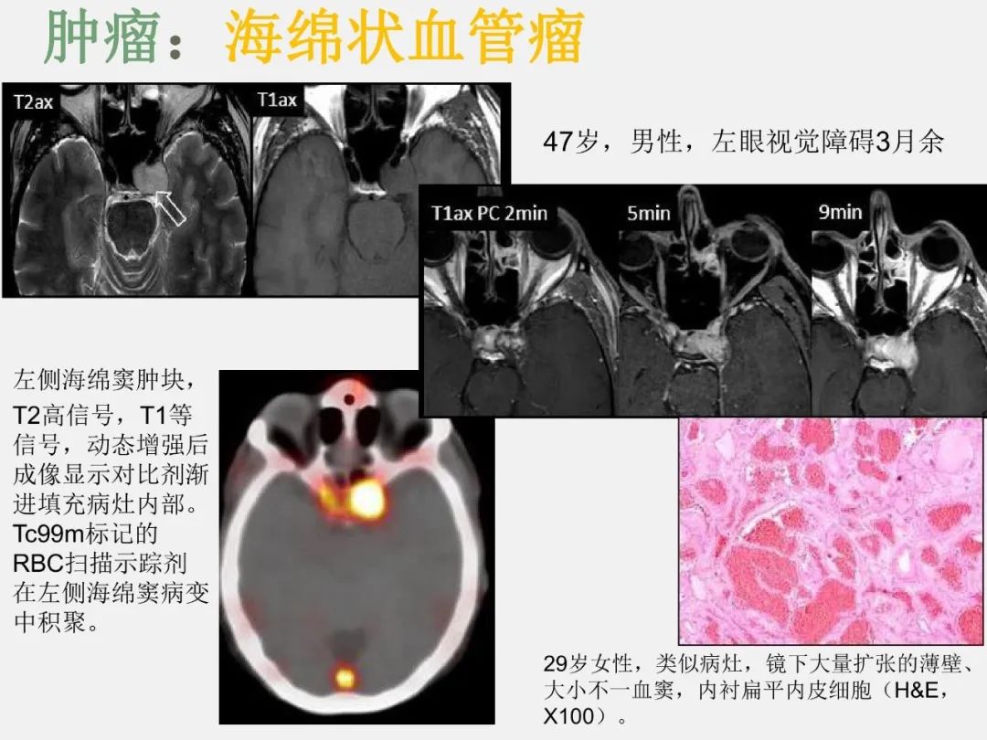 影像PPT - 【PPT】中枢神经系统血管病变—海绵窦影像病理对照-20