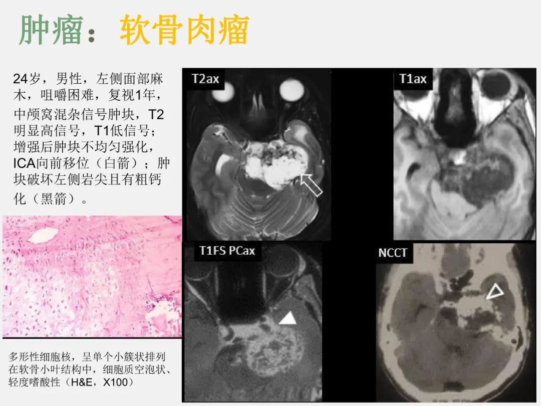 影像PPT - 【PPT】中枢神经系统血管病变—海绵窦影像病理对照-24