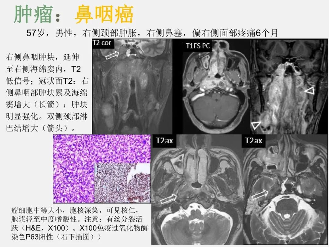 影像PPT - 【PPT】中枢神经系统血管病变—海绵窦影像病理对照-28