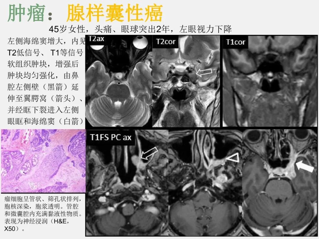 影像PPT - 【PPT】中枢神经系统血管病变—海绵窦影像病理对照-30