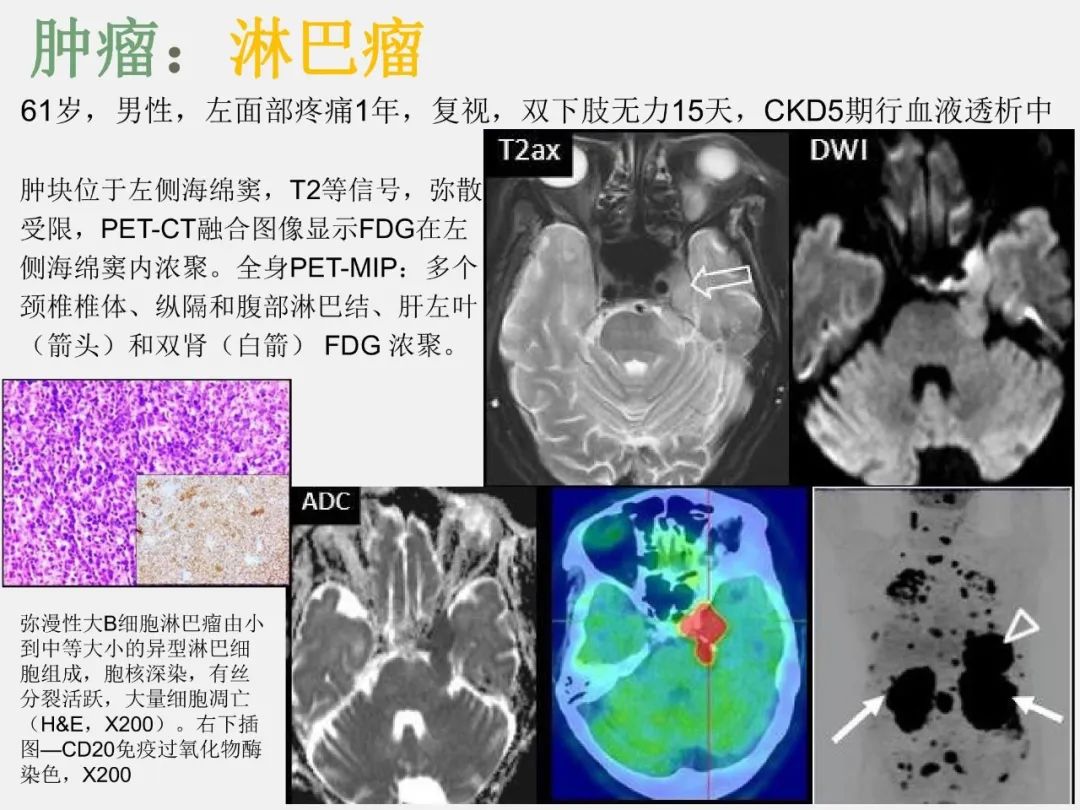 影像PPT - 【PPT】中枢神经系统血管病变—海绵窦影像病理对照-32