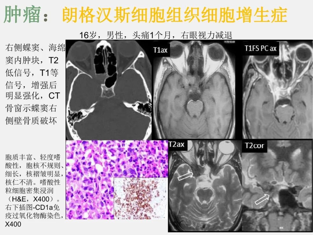 影像PPT - 【PPT】中枢神经系统血管病变—海绵窦影像病理对照-34