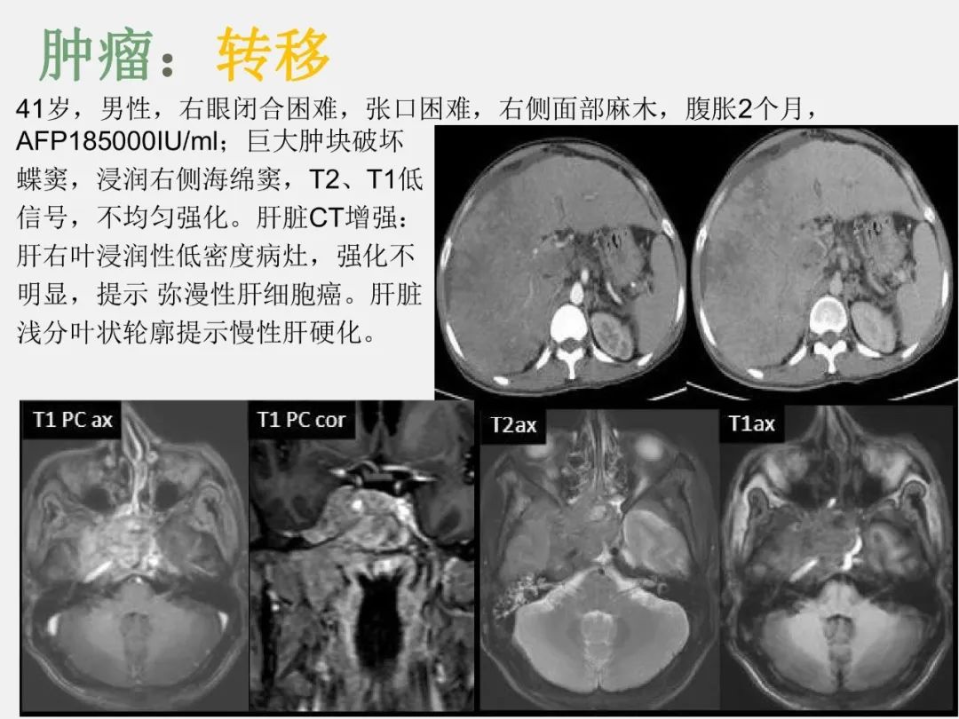 影像PPT - 【PPT】中枢神经系统血管病变—海绵窦影像病理对照-36