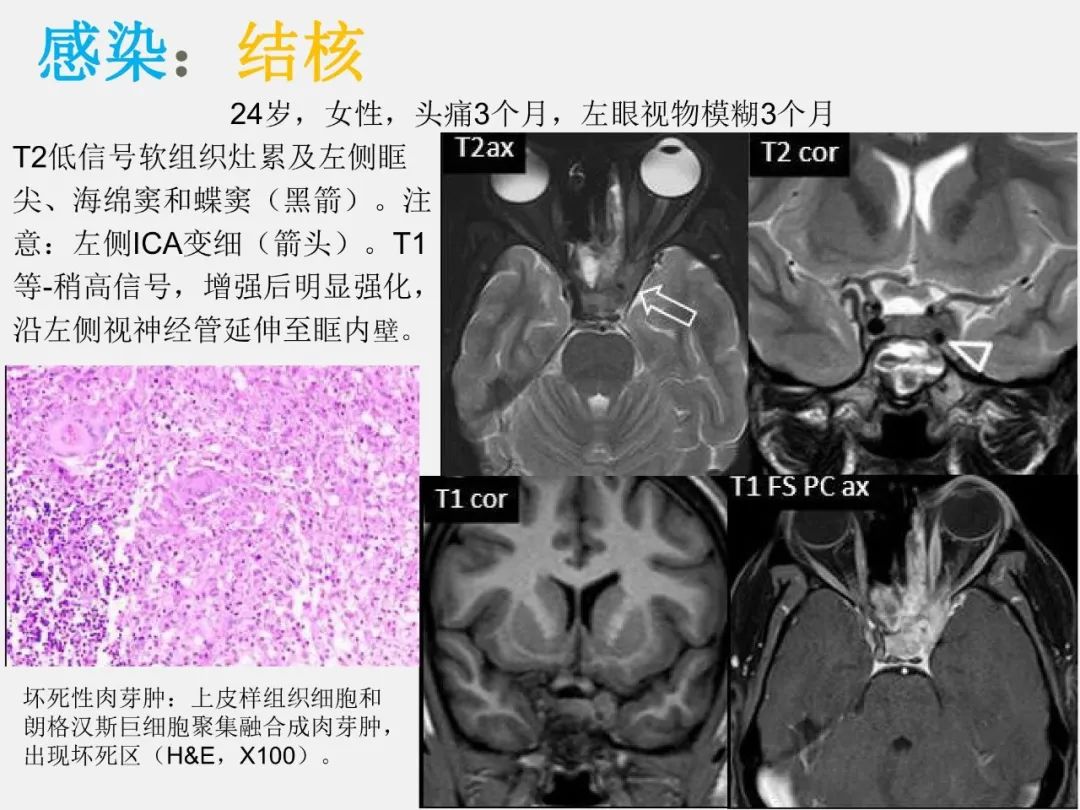 影像PPT - 【PPT】中枢神经系统血管病变—海绵窦影像病理对照-40