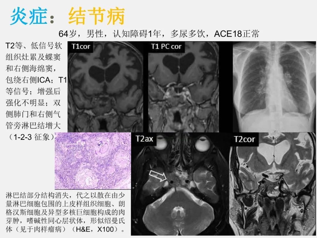 影像PPT - 【PPT】中枢神经系统血管病变—海绵窦影像病理对照-42