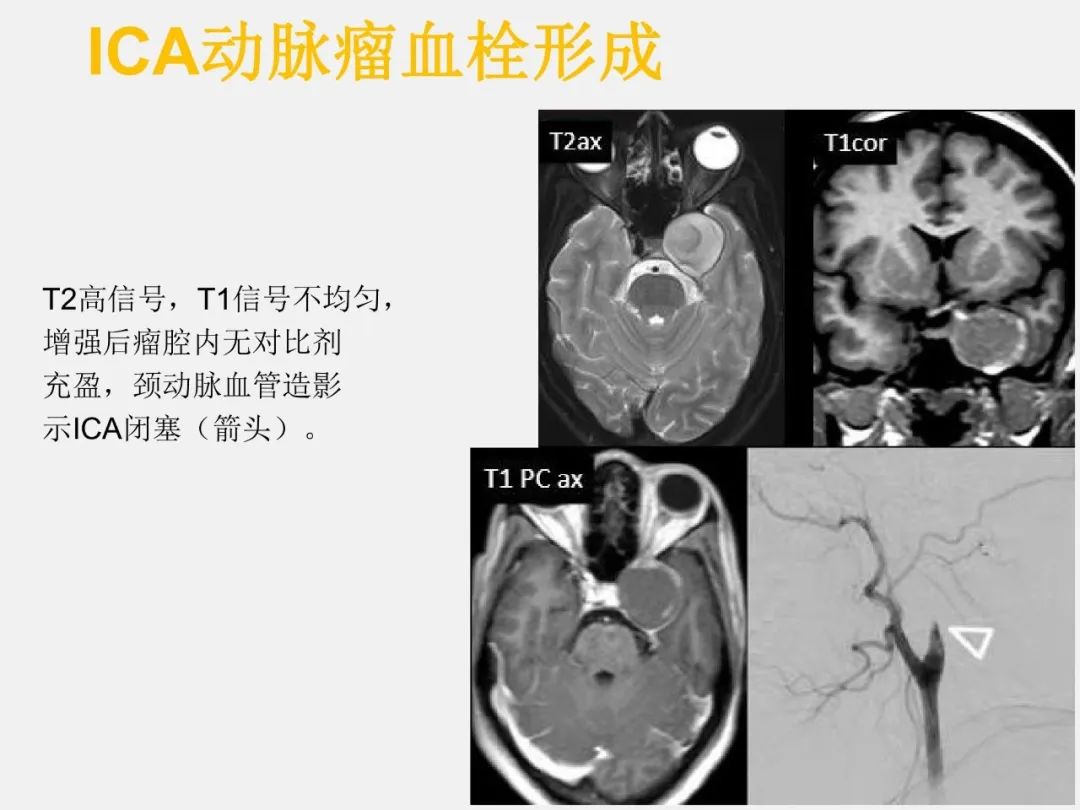 影像PPT - 【PPT】中枢神经系统血管病变—海绵窦影像病理对照-53