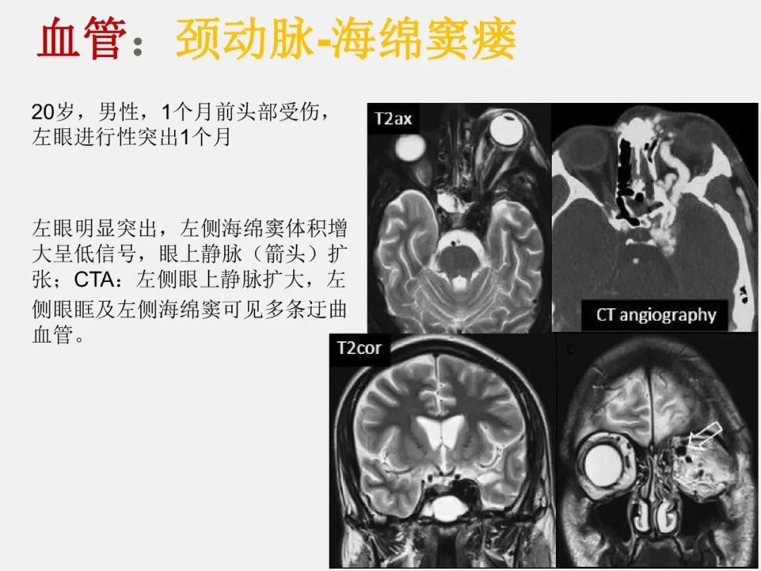 影像PPT - 【PPT】中枢神经系统血管病变—海绵窦影像病理对照-55