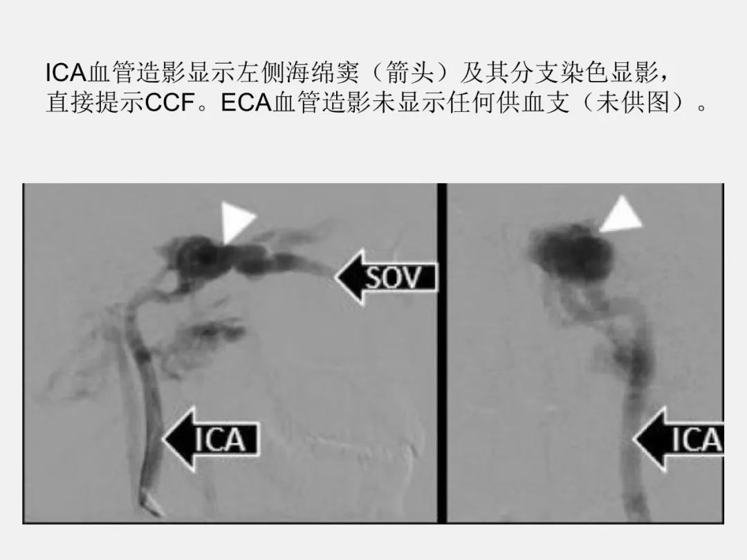 影像PPT - 【PPT】中枢神经系统血管病变—海绵窦影像病理对照-56