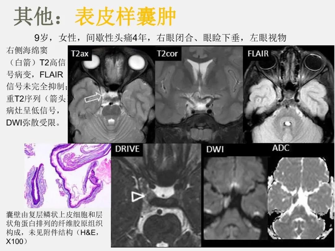 影像PPT - 【PPT】中枢神经系统血管病变—海绵窦影像病理对照-58