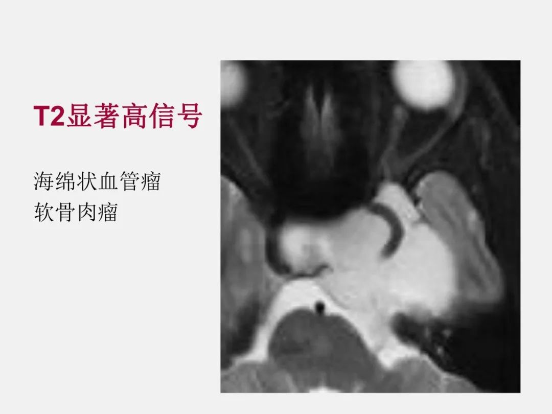 影像PPT - 【PPT】中枢神经系统血管病变—海绵窦影像病理对照-61
