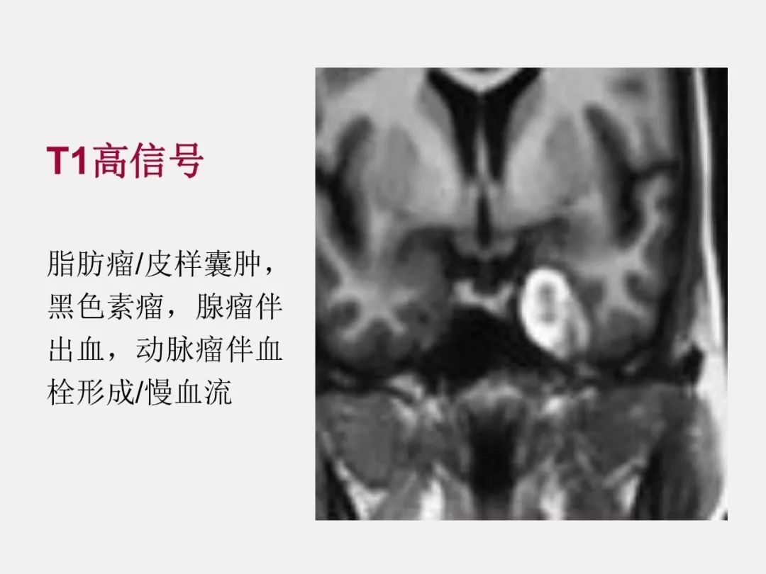 影像PPT - 【PPT】中枢神经系统血管病变—海绵窦影像病理对照-62
