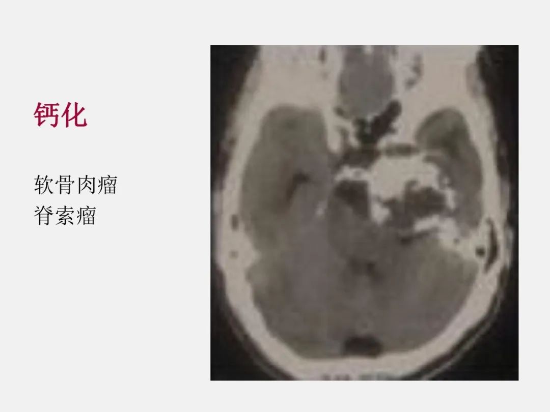 影像PPT - 【PPT】中枢神经系统血管病变—海绵窦影像病理对照-63