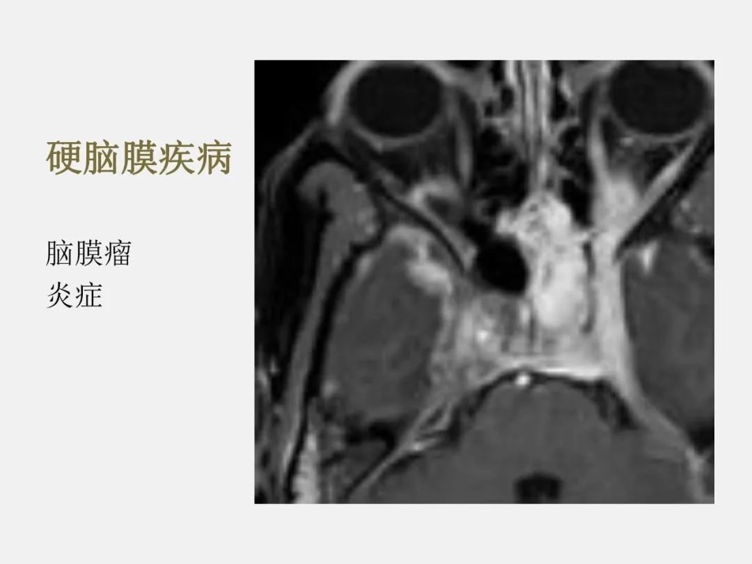 影像PPT - 【PPT】中枢神经系统血管病变—海绵窦影像病理对照-66