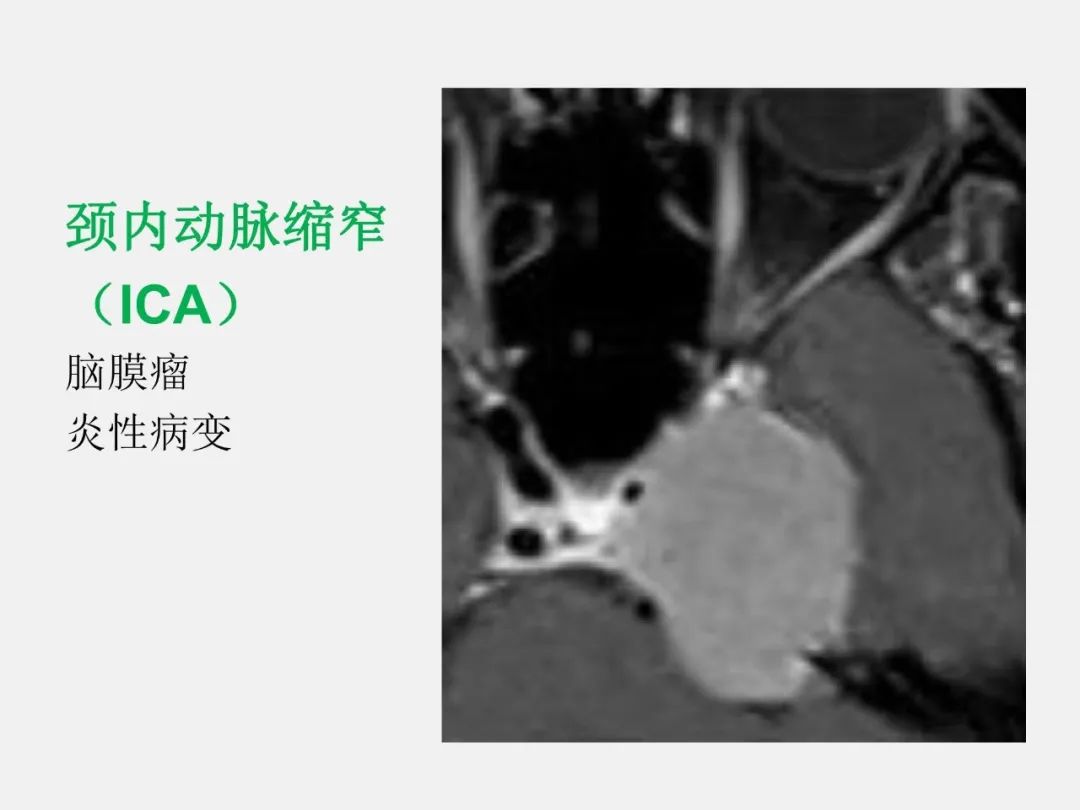 影像PPT - 【PPT】中枢神经系统血管病变—海绵窦影像病理对照-68