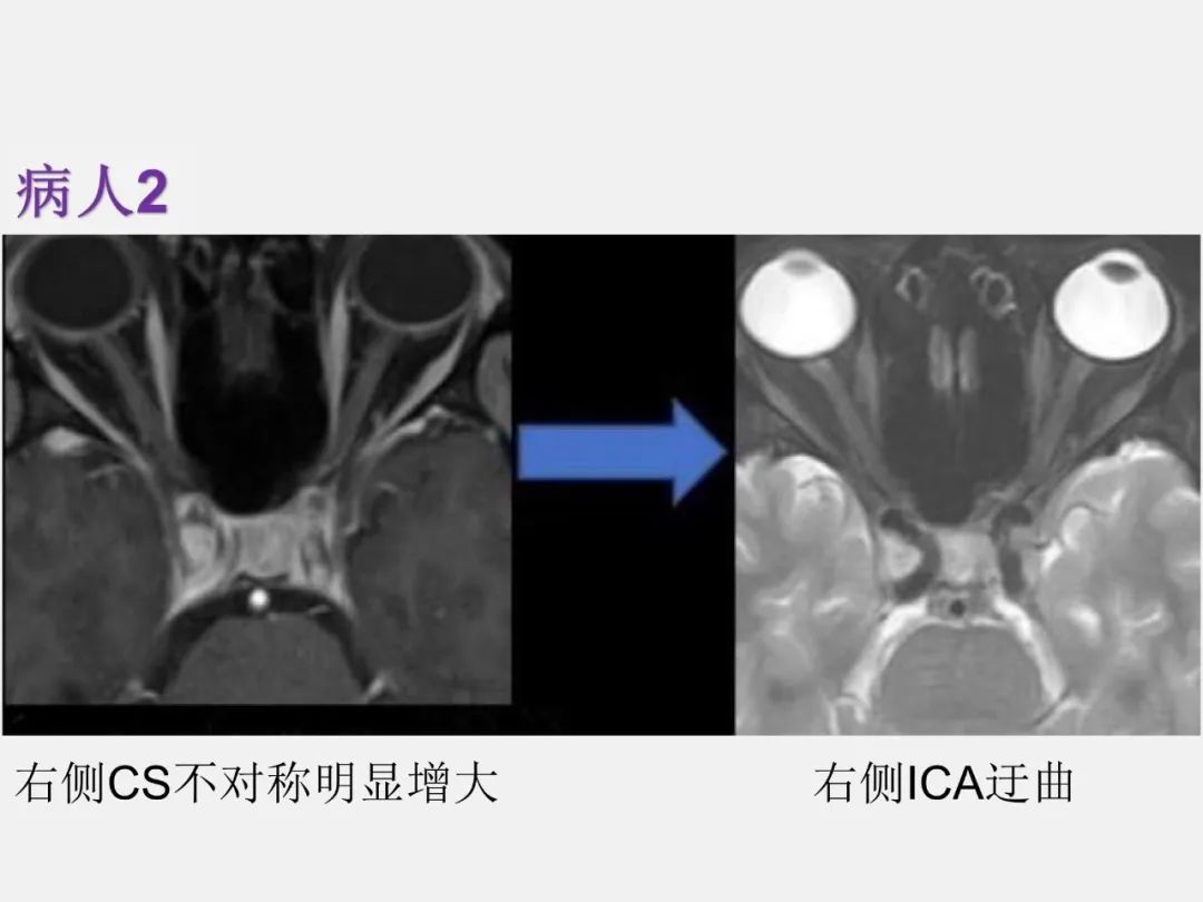 影像PPT - 【PPT】中枢神经系统血管病变—海绵窦影像病理对照-73