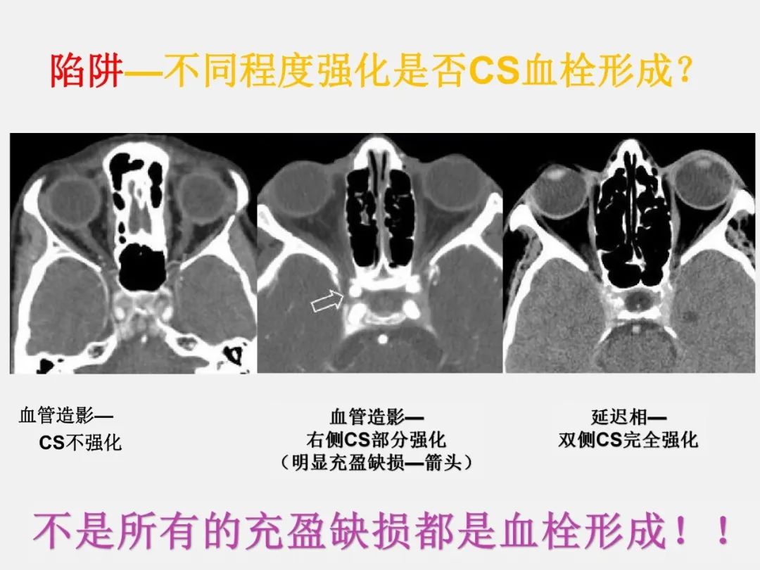 影像PPT - 【PPT】中枢神经系统血管病变—海绵窦影像病理对照-76