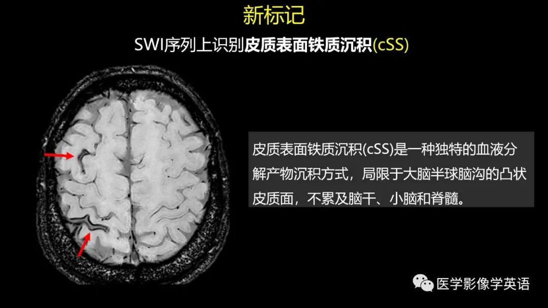 影像PPT - 【PPT】脑小血管病： 放射科医生须知-14