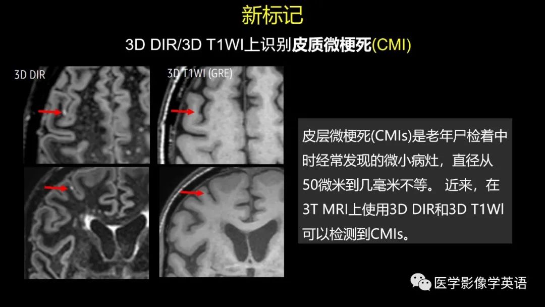影像PPT - 【PPT】脑小血管病： 放射科医生须知-16