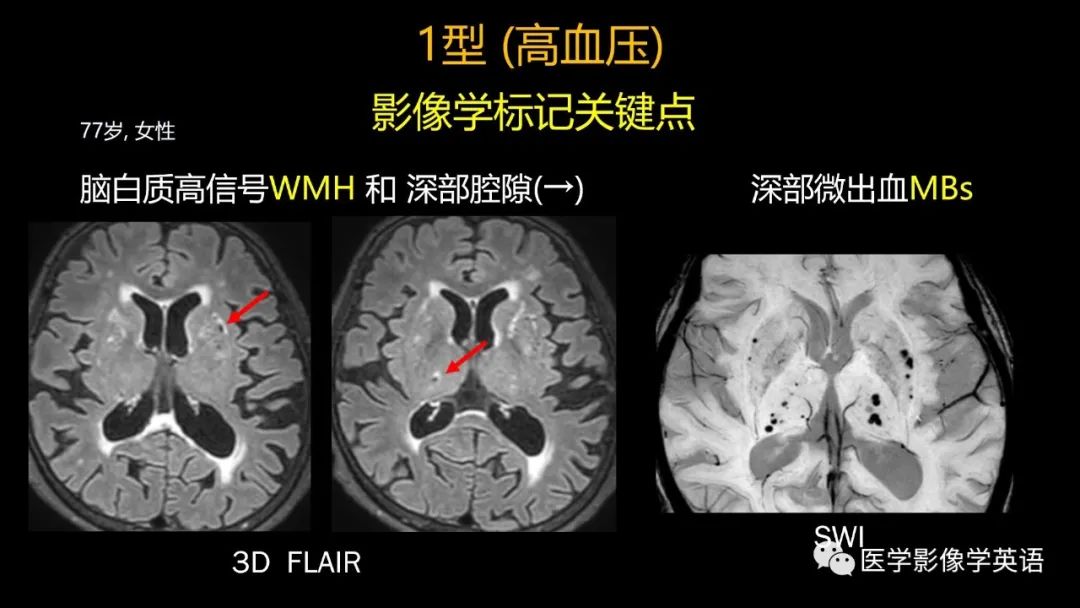 影像PPT - 【PPT】脑小血管病： 放射科医生须知-20