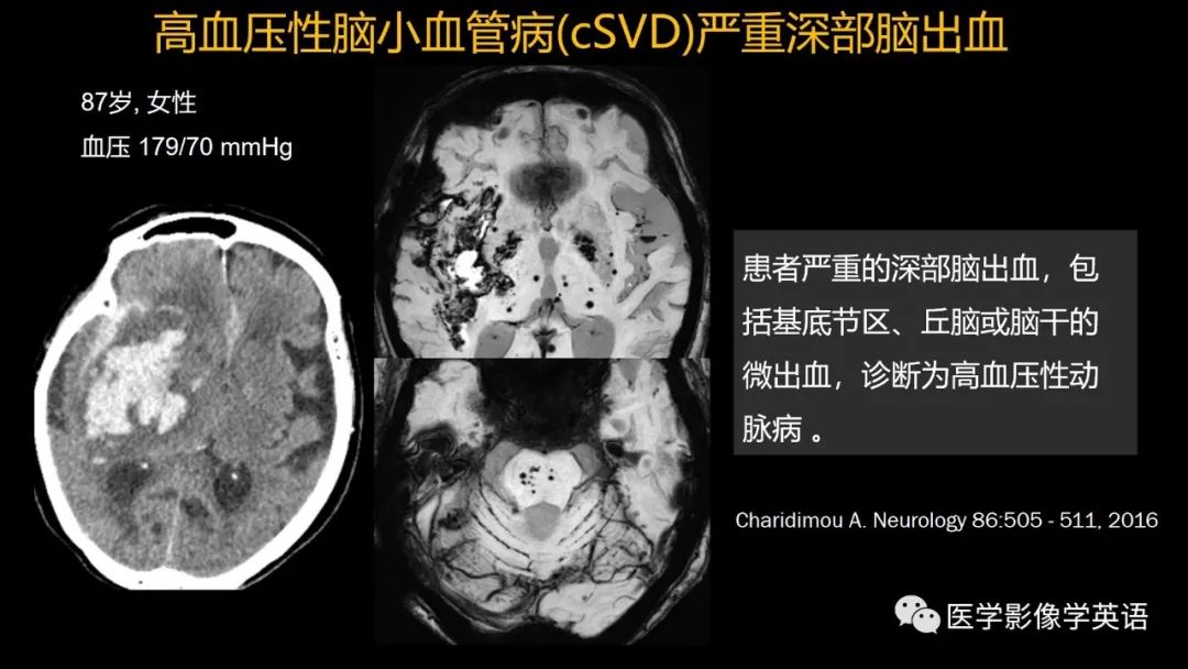 影像PPT - 【PPT】脑小血管病： 放射科医生须知-22