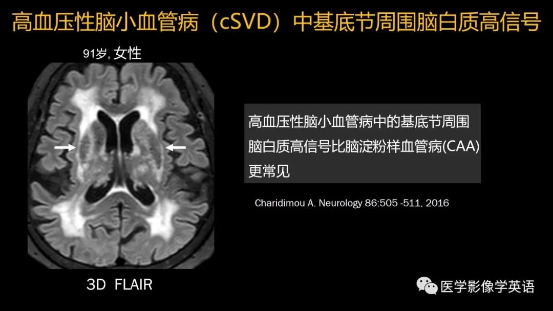 影像PPT - 【PPT】脑小血管病： 放射科医生须知-24