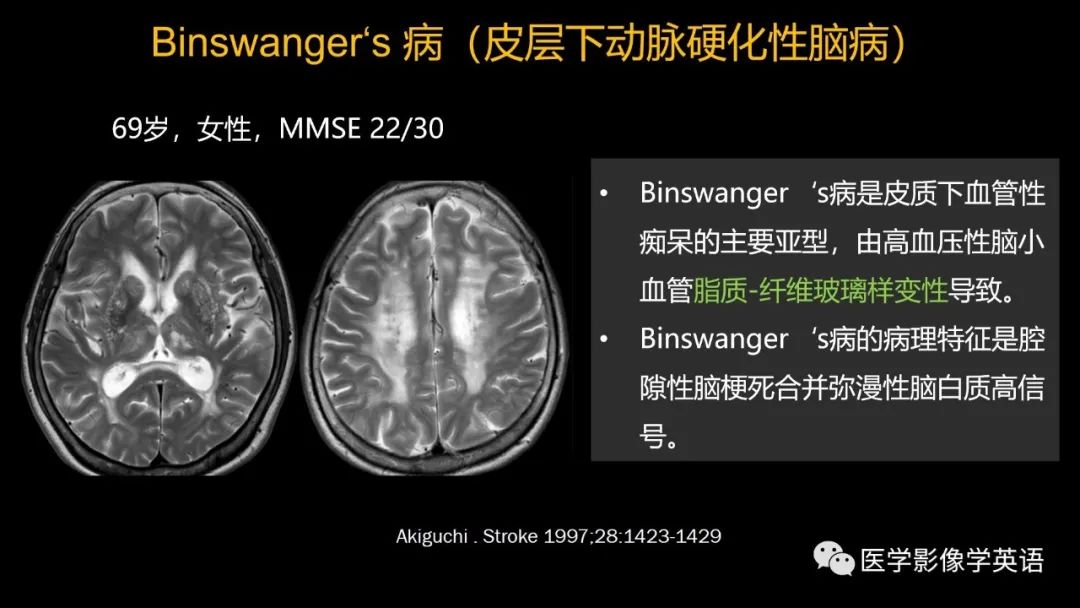 影像PPT - 【PPT】脑小血管病： 放射科医生须知-26