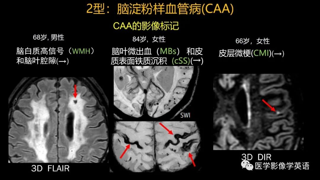 影像PPT - 【PPT】脑小血管病： 放射科医生须知-30