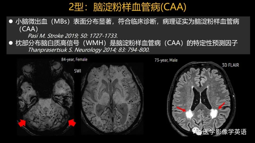影像PPT - 【PPT】脑小血管病： 放射科医生须知-32