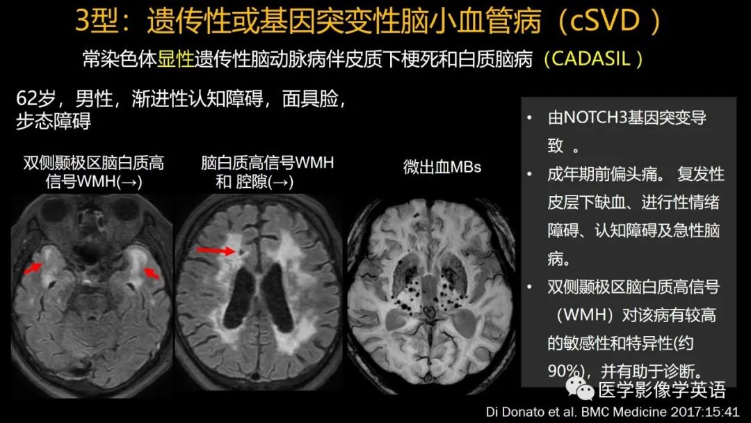 影像PPT - 【PPT】脑小血管病： 放射科医生须知-36