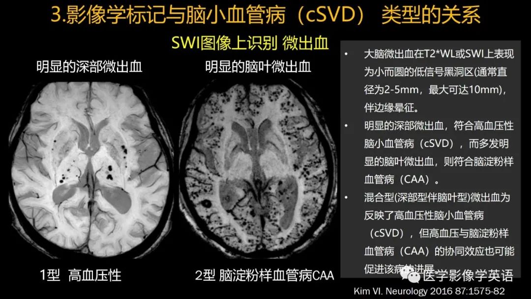 影像PPT - 【PPT】脑小血管病： 放射科医生须知-50