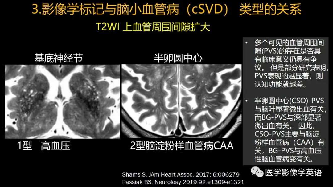 影像PPT - 【PPT】脑小血管病： 放射科医生须知-52