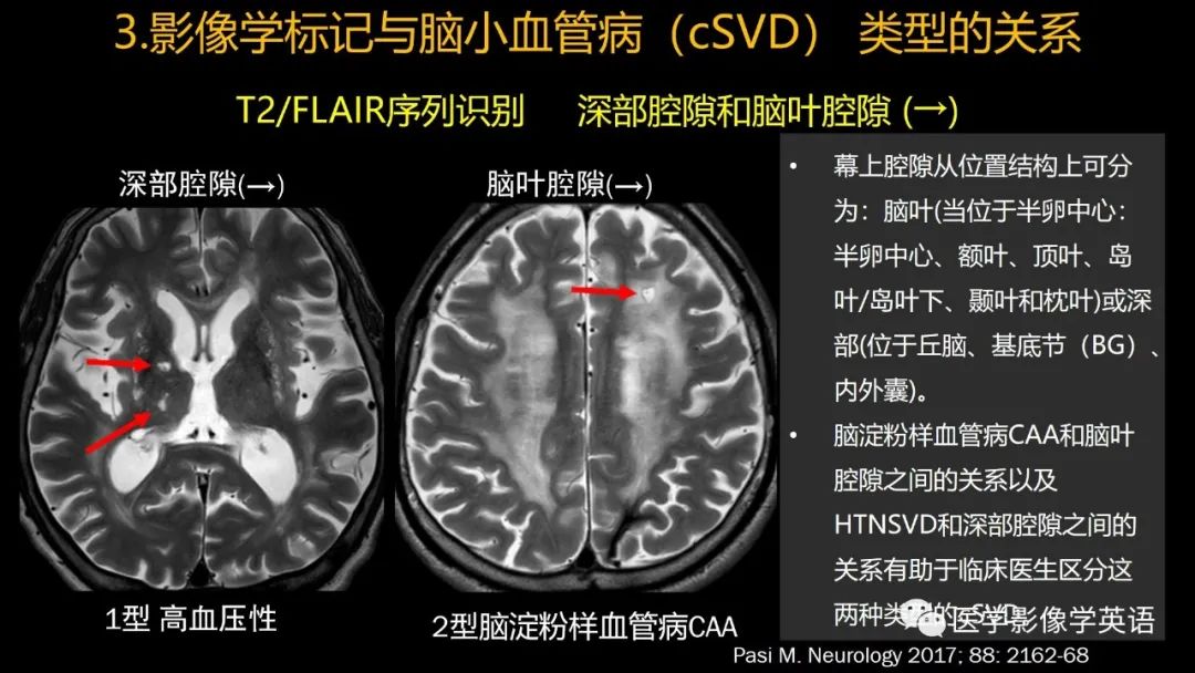 影像PPT - 【PPT】脑小血管病： 放射科医生须知-48