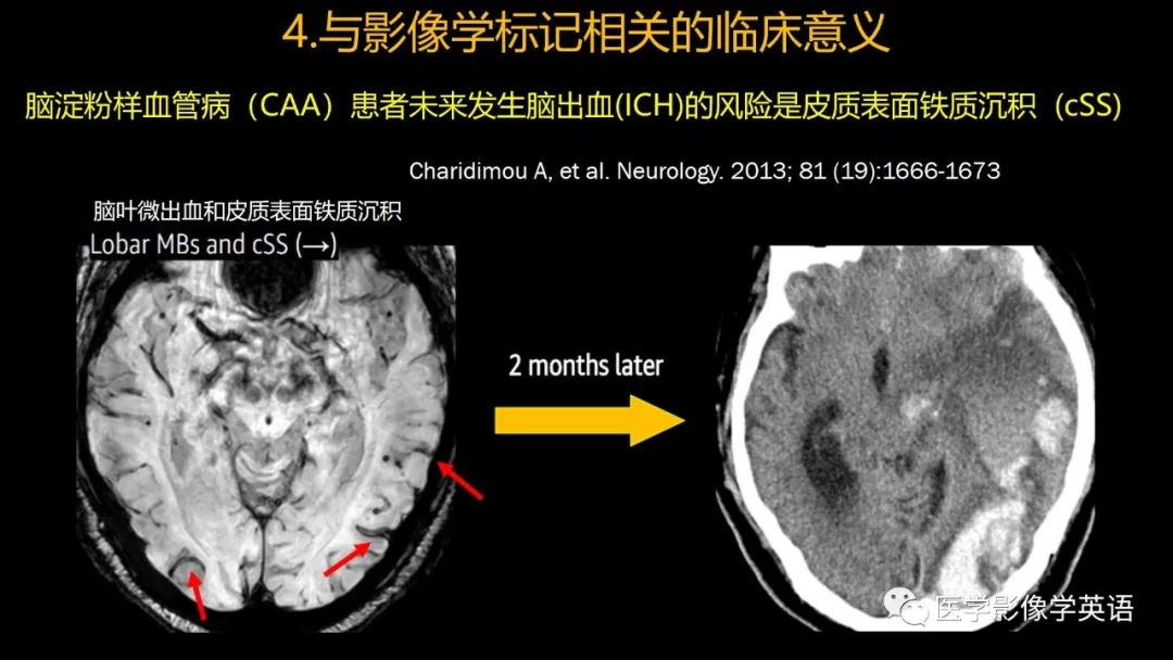 影像PPT - 【PPT】脑小血管病： 放射科医生须知-54