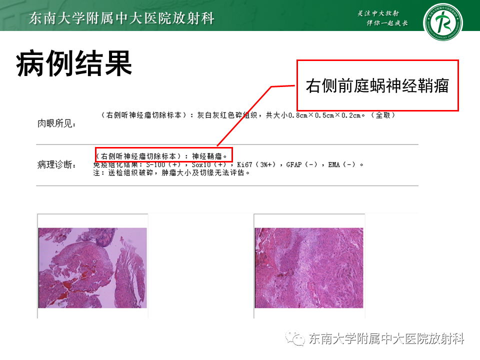 影像PPT - 【PPT】成人桥小脑角区常见肿瘤-3