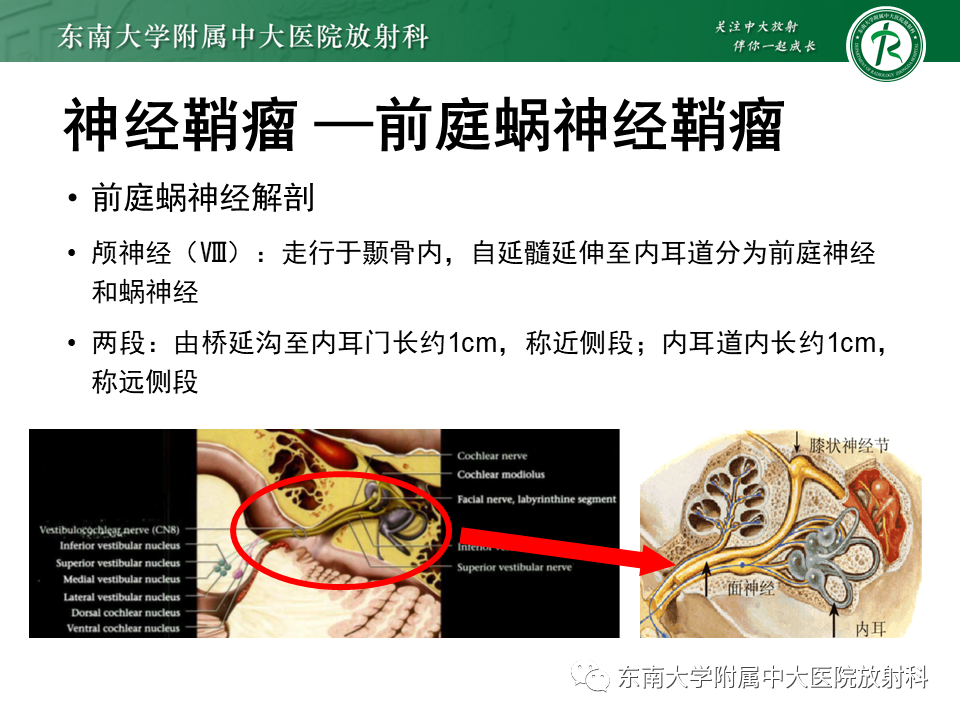 影像PPT - 【PPT】成人桥小脑角区常见肿瘤-13