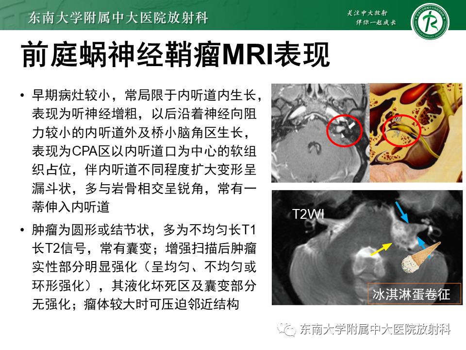 影像PPT - 【PPT】成人桥小脑角区常见肿瘤-16
