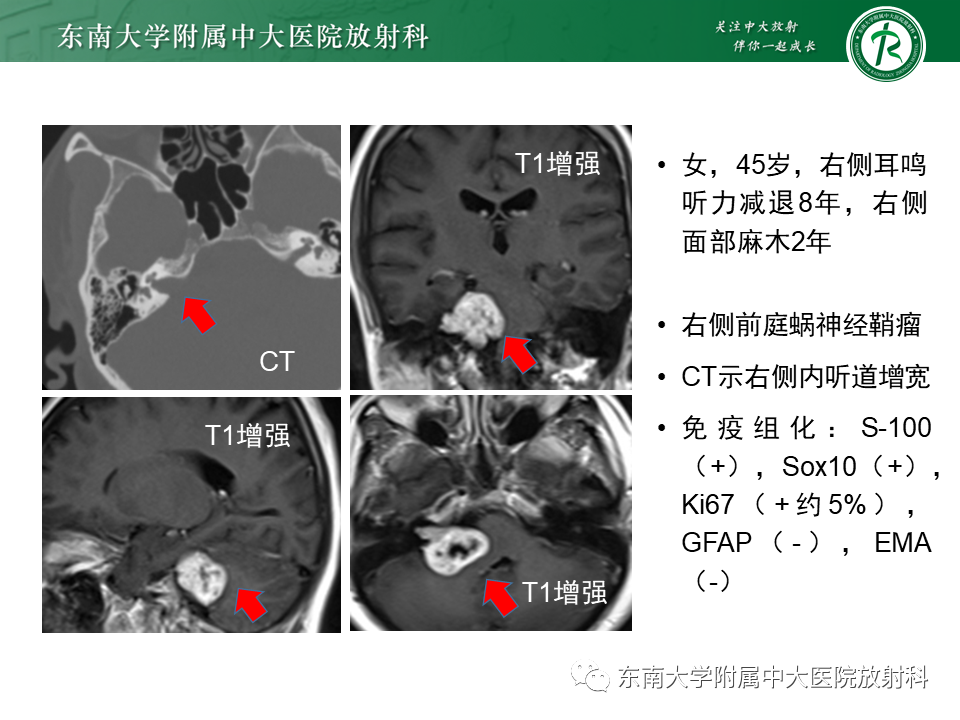影像PPT - 【PPT】成人桥小脑角区常见肿瘤-17