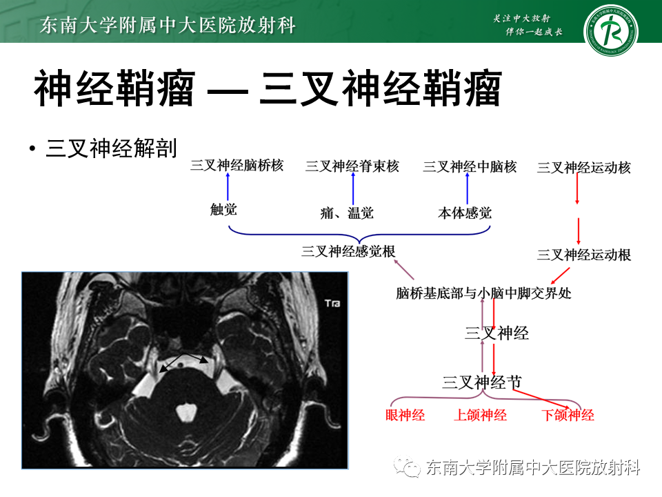 影像PPT - 【PPT】成人桥小脑角区常见肿瘤-18