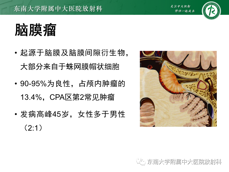 影像PPT - 【PPT】成人桥小脑角区常见肿瘤-22