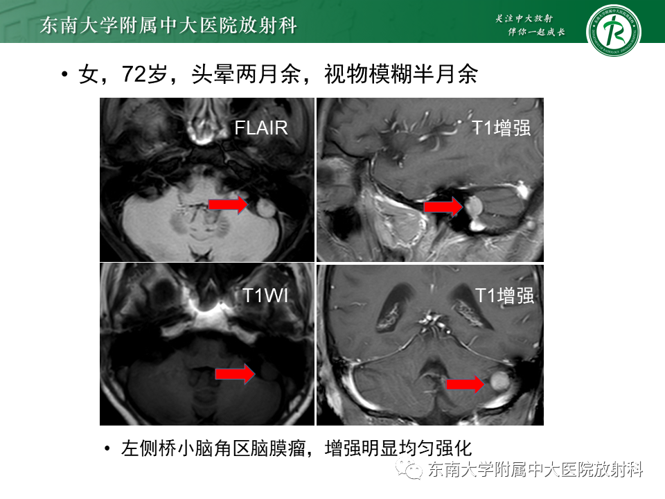 影像PPT - 【PPT】成人桥小脑角区常见肿瘤-24