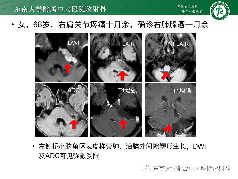 影像PPT - 【PPT】成人桥小脑角区常见肿瘤-27