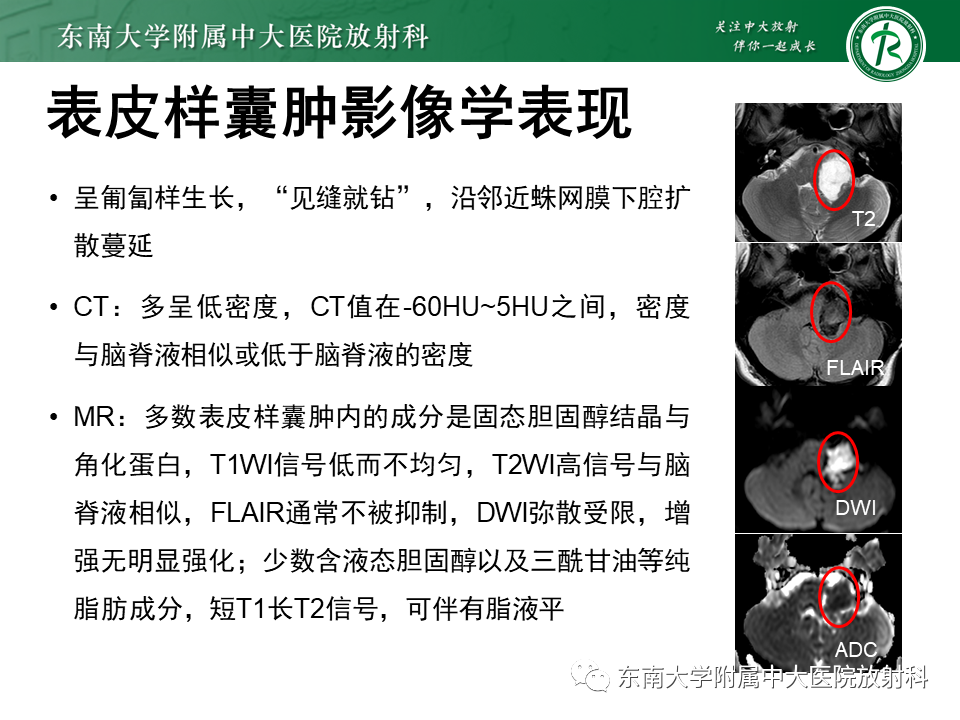 影像PPT - 【PPT】成人桥小脑角区常见肿瘤-26