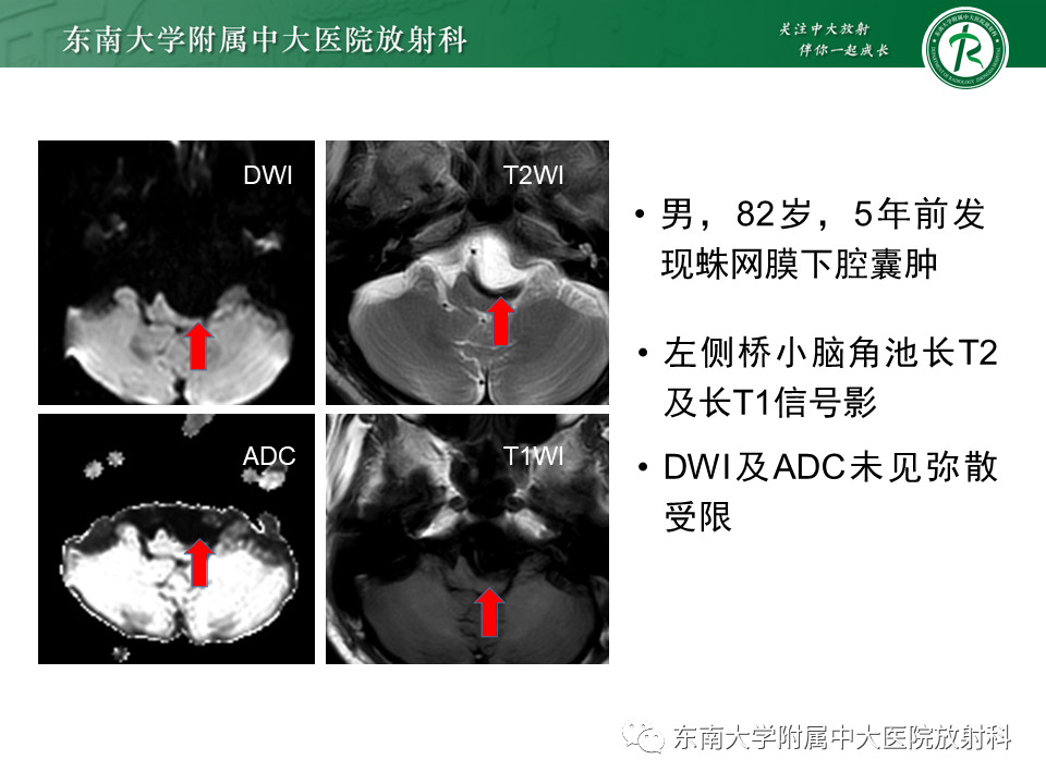 影像PPT - 【PPT】成人桥小脑角区常见肿瘤-29