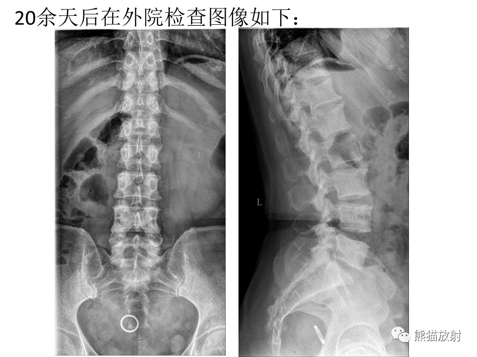 影像PPT - 【PPT】脊柱结核2例CT及MR影像-30