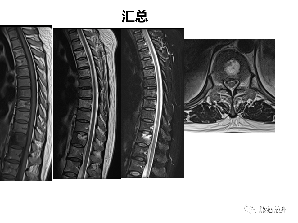 影像PPT - 【PPT】脊柱结核2例CT及MR影像-39