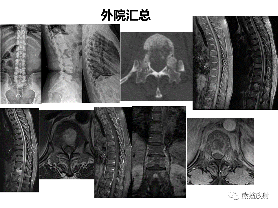 影像PPT - 【PPT】脊柱结核2例CT及MR影像-40