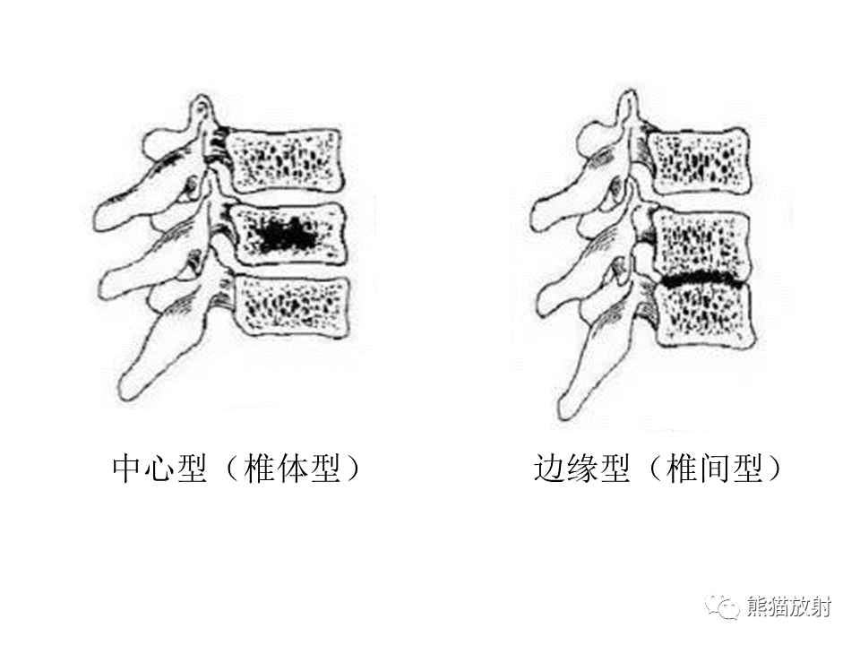 影像PPT - 【PPT】脊柱结核2例CT及MR影像-46