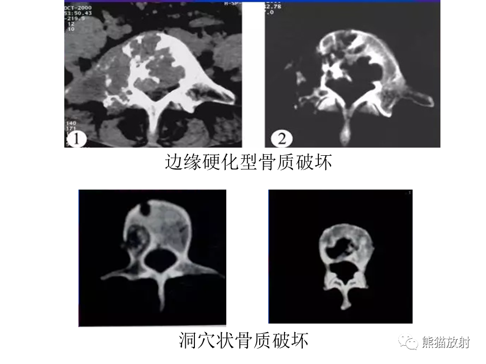 影像PPT - 【PPT】脊柱结核2例CT及MR影像-49