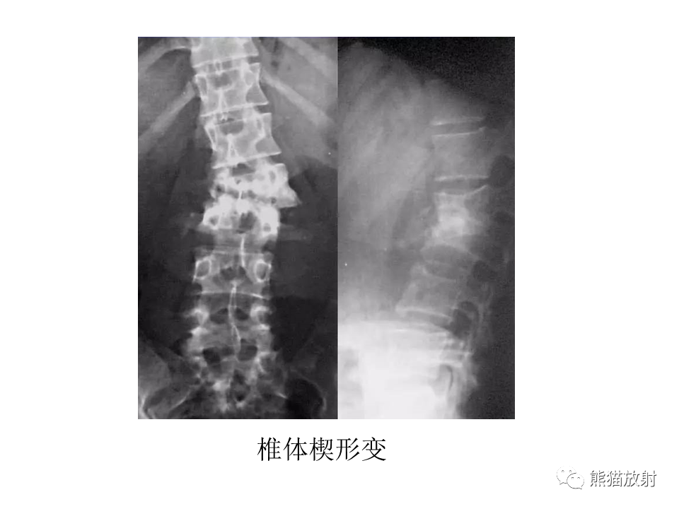 影像PPT - 【PPT】脊柱结核2例CT及MR影像-50