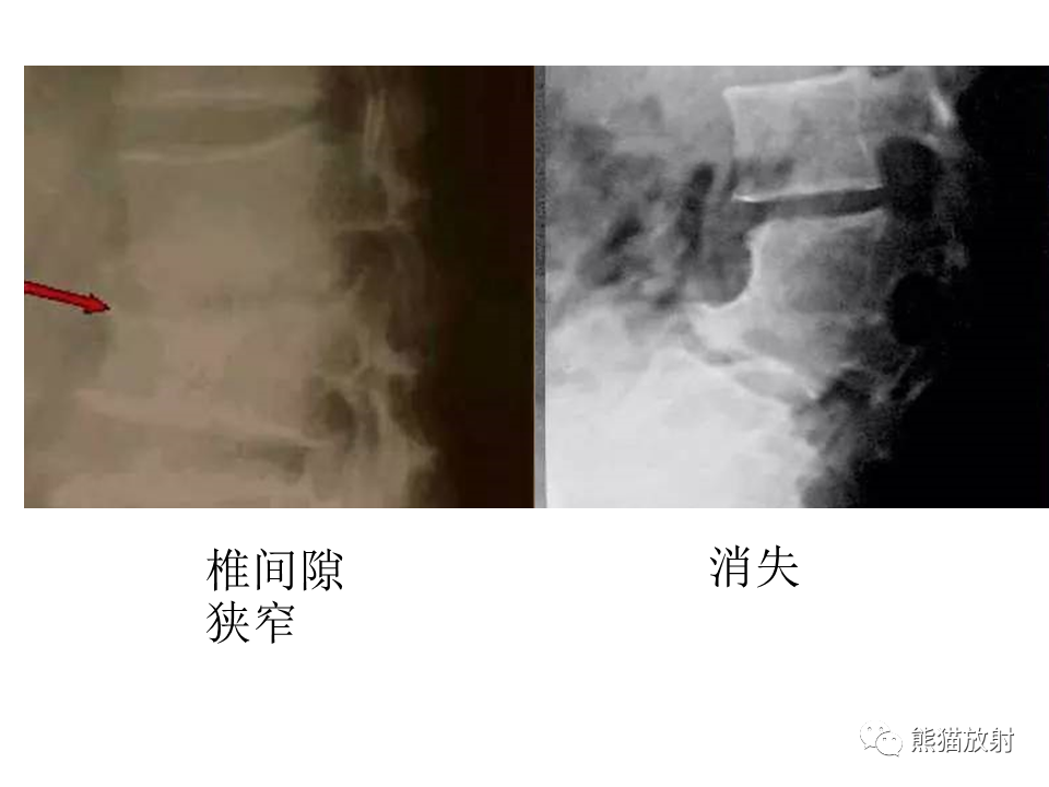 影像PPT - 【PPT】脊柱结核2例CT及MR影像-51